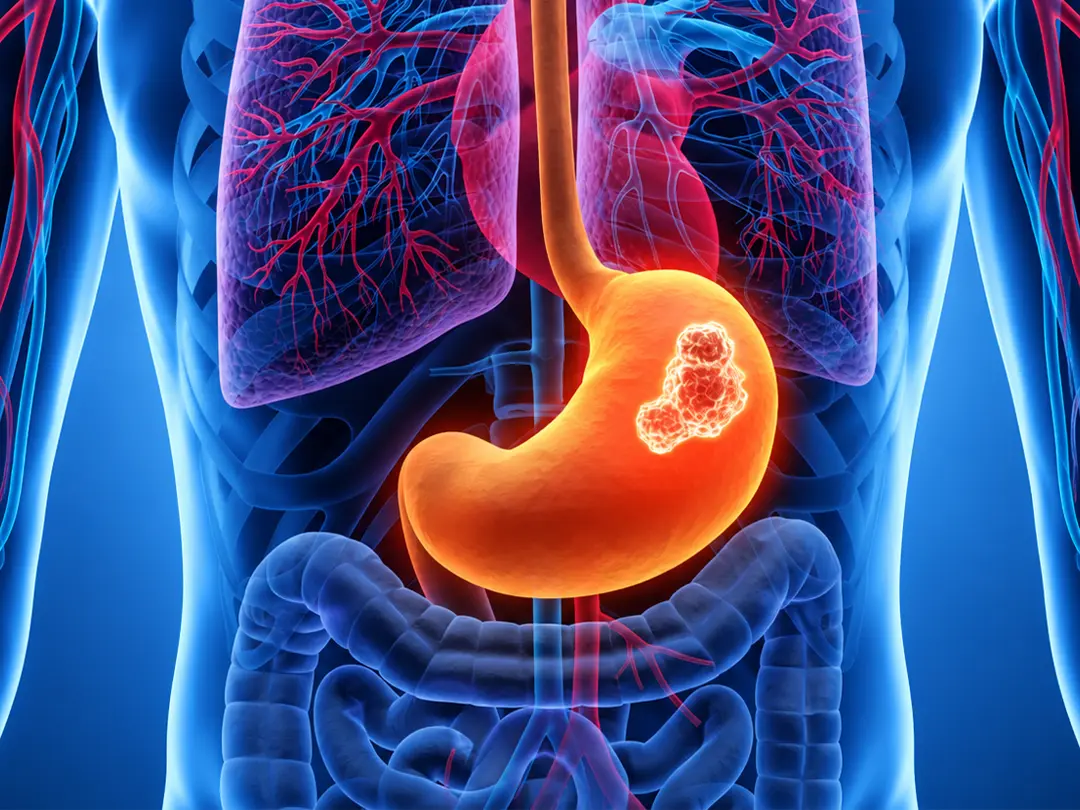 Personalized Gastric Cancer Treatment
