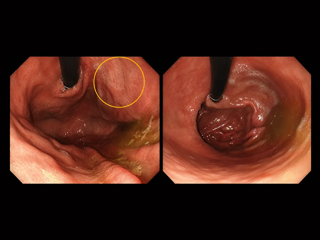 Personalized Gastric Cancer Treatment