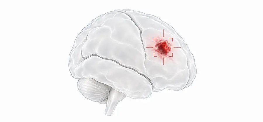 BNCT for Malignant Brain Tumors