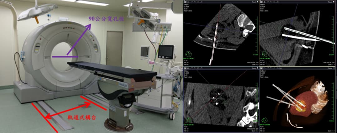 Renal Tumor Cryoablation Treatment