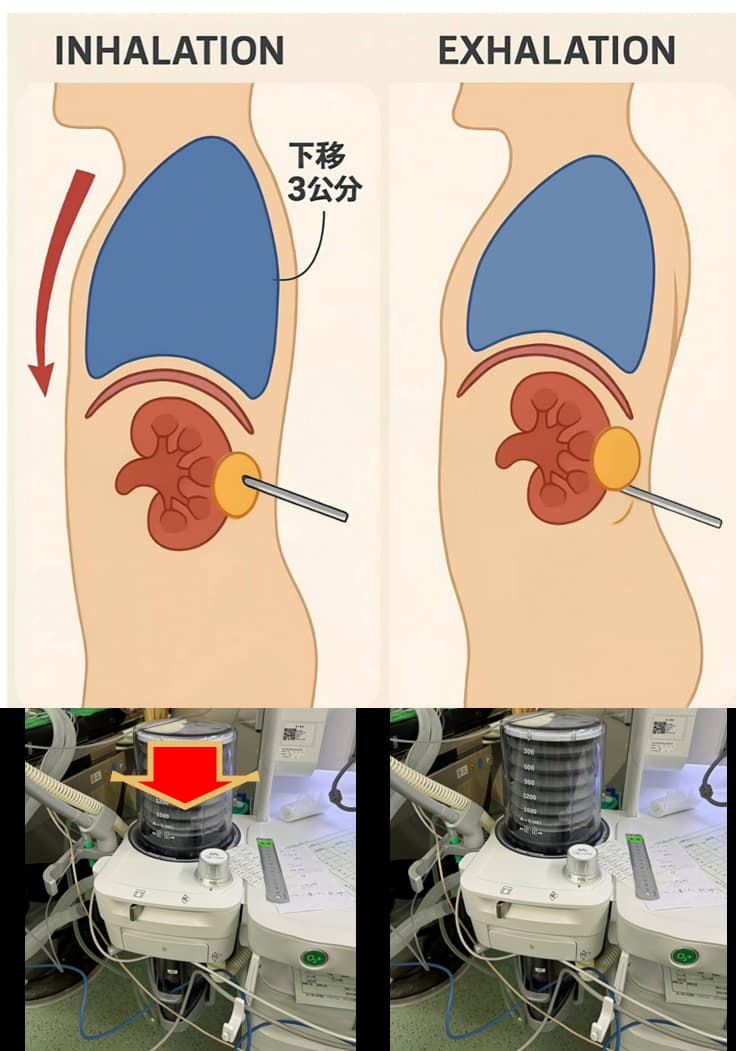 Renal Tumor Cryoablation Treatment
