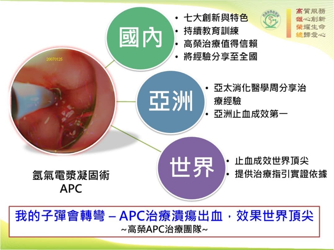 Argon plasma  for endoscopic hemostasis