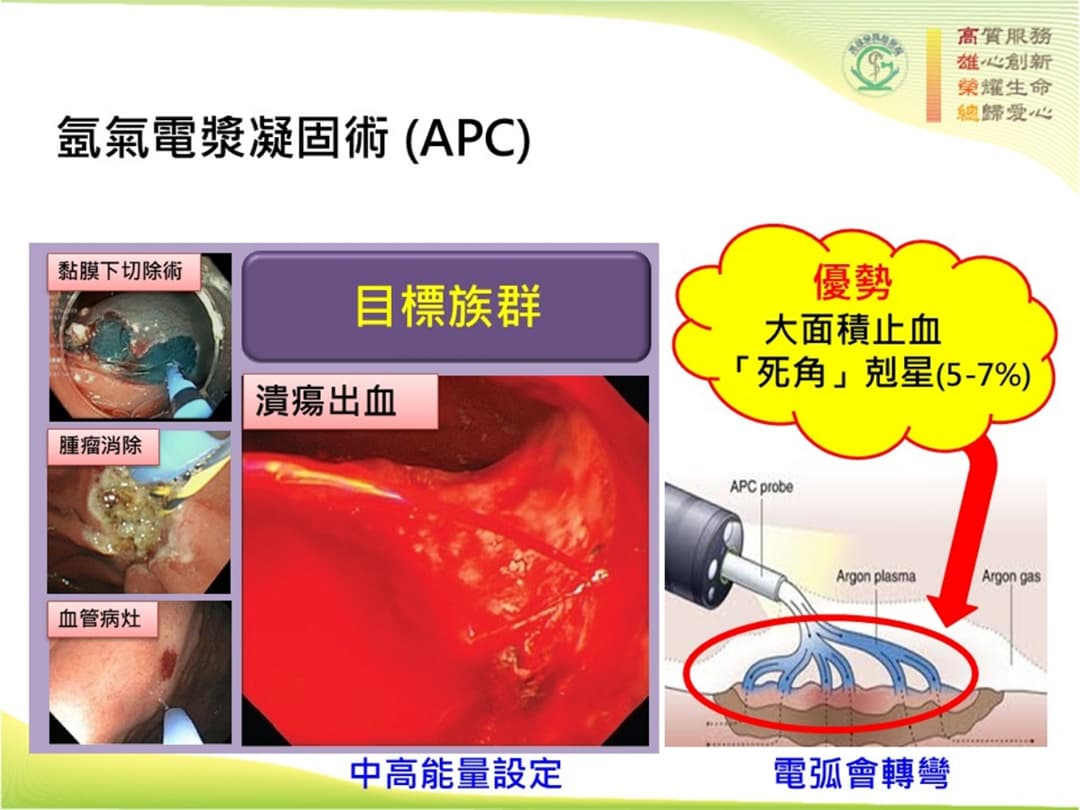 Argon plasma  for endoscopic hemostasis