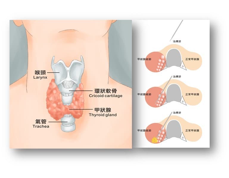 頭頸部腫瘤微創消融治療