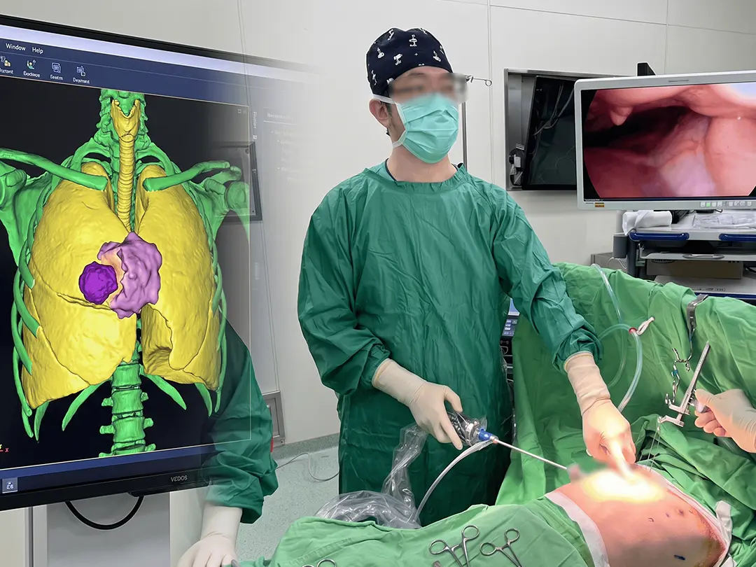 3D-Printed Correction for Pectus Excavatum