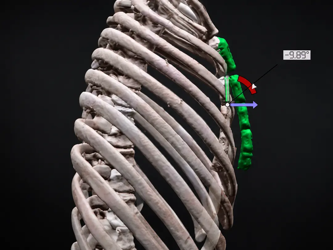 3D-Printed Correction for Pectus Excavatum