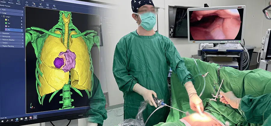 漏斗胸3D列印矯正手術
