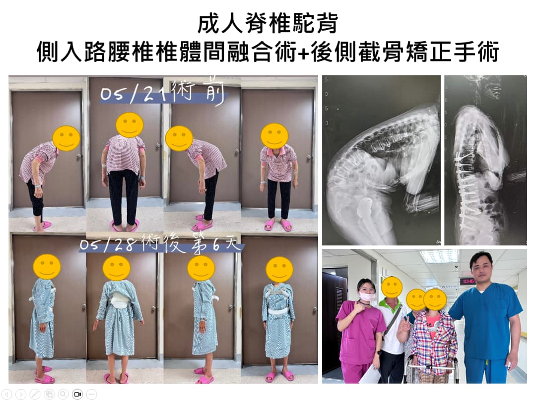 Complex Spinal Deformity Correction
