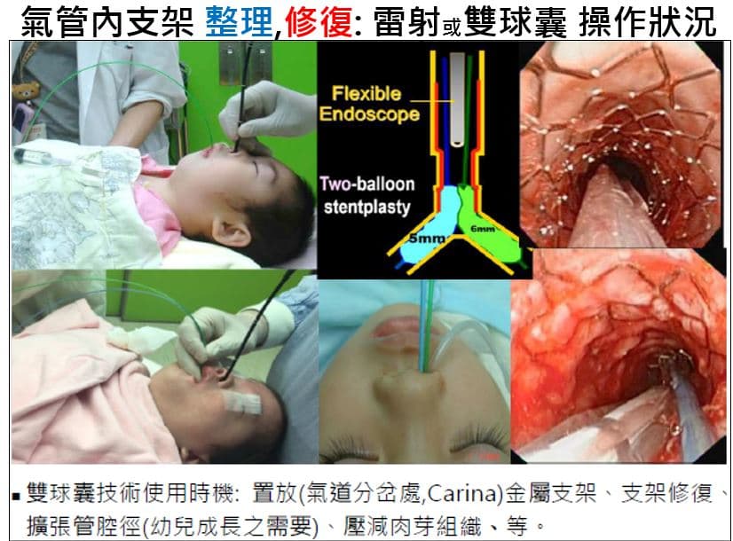 Song's Simple Resuscitative Ventilation