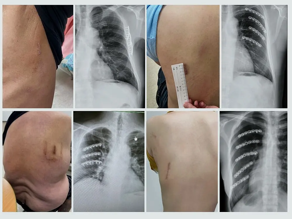 MIS for Thoracic Trauma & Rib Fracture