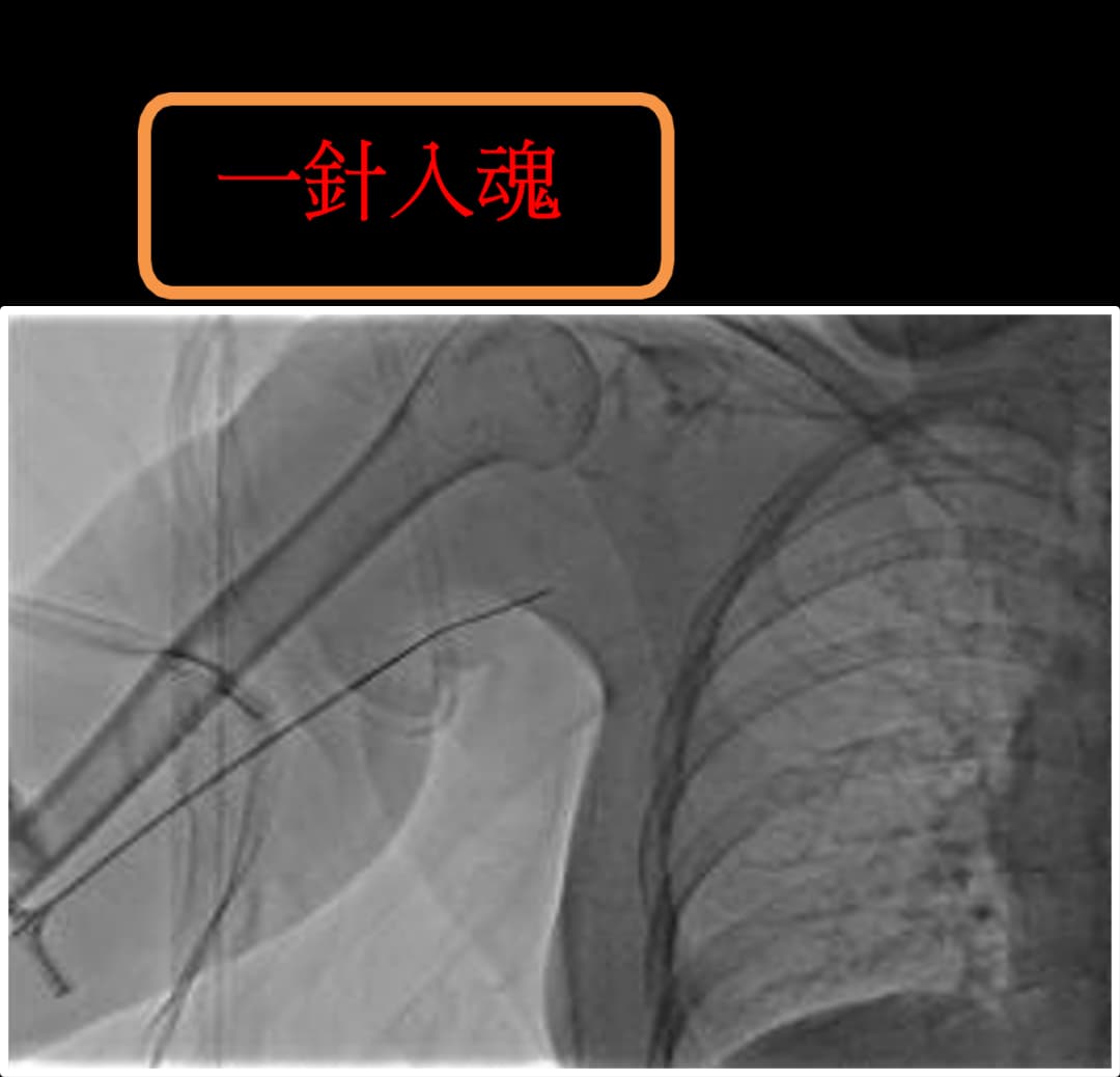 透視導引靜脈導管置放