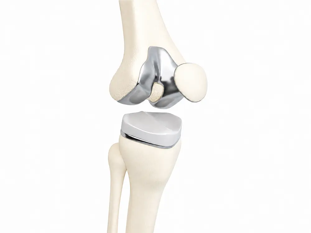 Integrated Joint Replacement Care Model