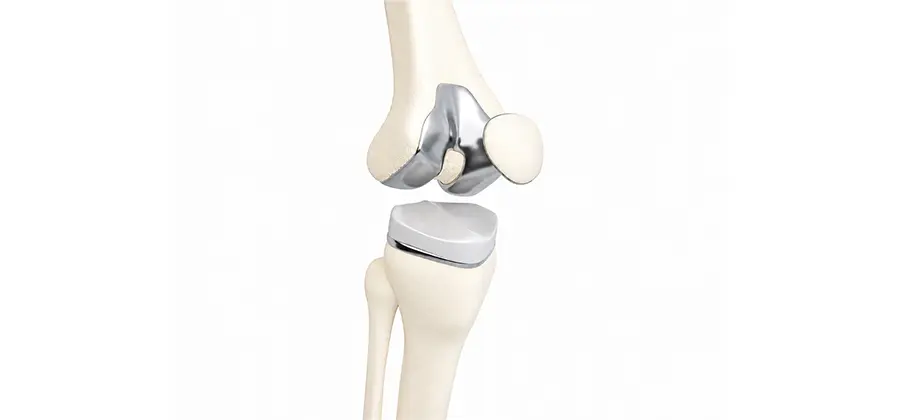 Integrated Joint Replacement Care Model
