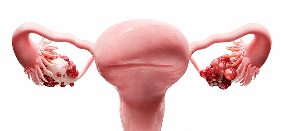Gynecologic cancer