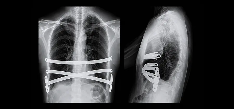 Nuss procedure : Team Medical care model
