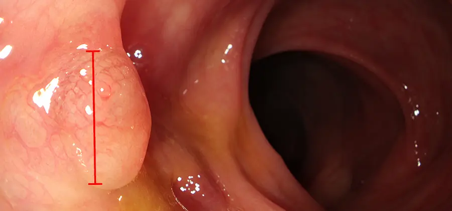 AI-Assisted Colorectal Cancer Screening
