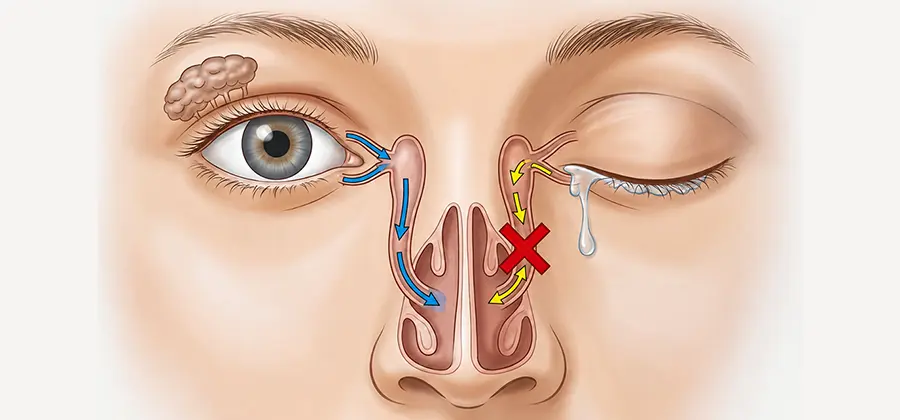 Endoscopic Surgery for Nasolacrimal Duct Obstruction
