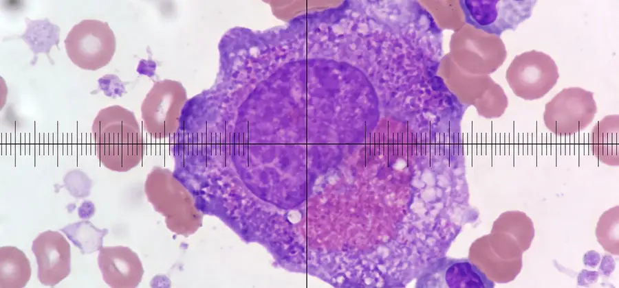 Pediatric Haploidentical Stem Cell Transplant