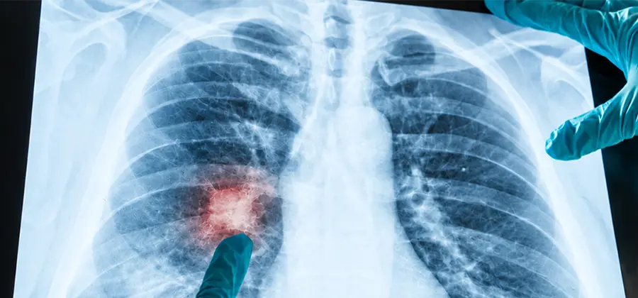 Risk-Prediction Screening for Early Lung Cancer