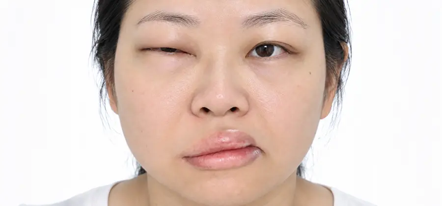 Precision care for fatal angioedema：Protecting rare diseases, keeping healthy and zero emergency