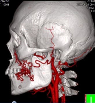 Management of Hemangiomas and Vascular Malformations
