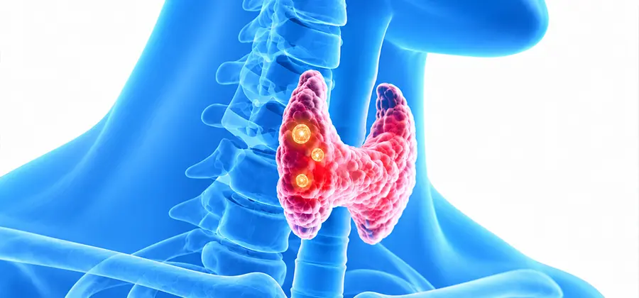 Minimally Invasive Thyroid Tumor Treatment