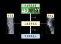 新膝相印-3D列印關節骨水泥,感染治療新膝望